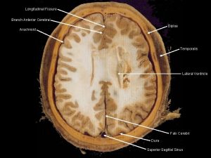 Longitudinal Fissure Branch Anterior Cerebral Diploe Arachnoid Temporalis