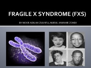 FRAGILE X SYNDROME FXS BY NOOR ADILAH ZULKIFLI