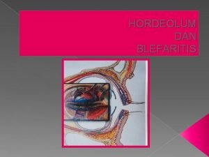 HORDEOLUM DAN BLEFARITIS HORDEOLUM Inflamasi supurative akut pada