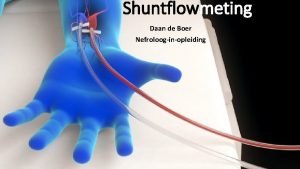 Radiocephalic shunt Radiocephalic shunt