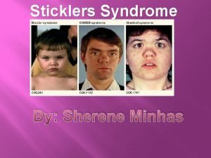 Stickler syndrome pictures