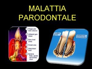 MALATTIA PARODONTALE Patologia infiammatoria delle strutture anatomiche di