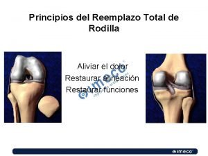 Principios del Reemplazo Total de Rodilla Aliviar el