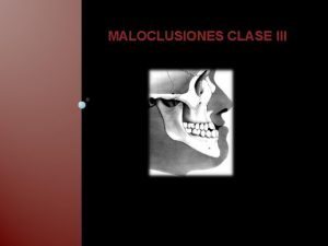 MALOCLUSIONES CLASE III CLASE III Segn la clasificacin