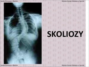 Skolioza wielołukowa