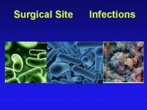 Surgical Site Infections Ignaz Semmelweis 1847 Realized that