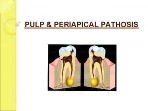 PULP PERIAPICAL PATHOSIS INTRODUCTION Inflammation of pulp and