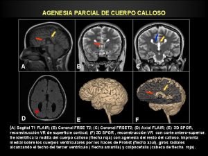 AGENESIA PARCIAL DE CUERPO CALLOSO A B C