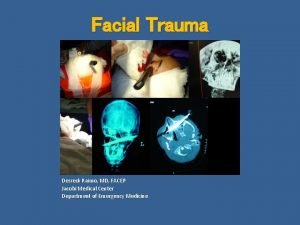 Facial Trauma Derreck Raimo MD FACEP Jacobi Medical