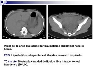 Quiste endometriósico