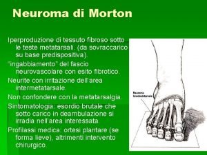Neuroma di Morton Iperproduzione di tessuto fibroso sotto