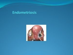 Endometriosis Presence of endometrial tissue glands stroma outside