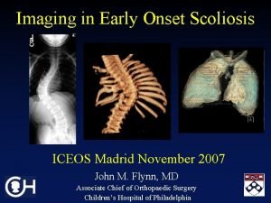 Imaging in Early Onset Scoliosis ICEOS Madrid November