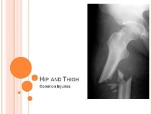 HIP AND THIGH Common Injuries STRAINS Quad Hip