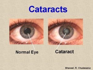 Cataracts Normal Eye Cataract Bhaveet R Chudasama What