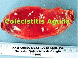 Colecistitis Aguda XXII CURSO DE CIRUGIA GENERAL Sociedad