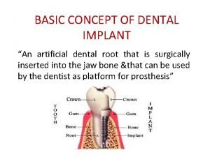 BASIC CONCEPT OF DENTAL IMPLANT An artificial dental