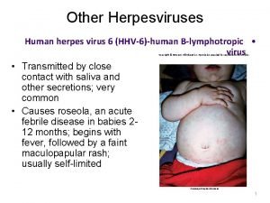 Other Herpesviruses Human herpes virus 6 HHV6human Blymphotropic