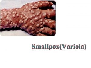 SmallpoxVariola Caused by Variola virus Characterized by sudden