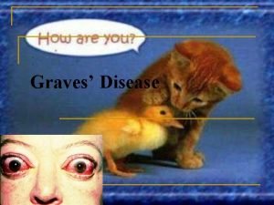 Graves Disease Epidemiology n Prevalence of hyperthyroidism in