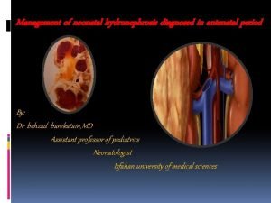 Congenital hydronephrosis