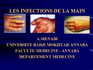 LES INFECTIONS DE LA MAIN A MENADI UNIVERSITE