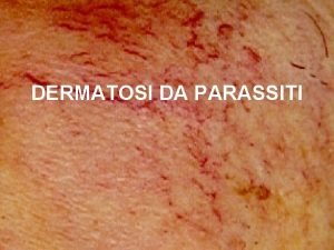 DERMATOSI DA PARASSITI Scabbia La scabbia una dermatosi