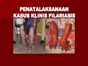 FILARIASIS q PENYAKIT MENULAR MENAHUN DISEBABKAN CACING FILARIA