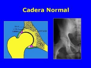 Torsion femoral interna