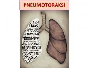 Pneumotoraksi