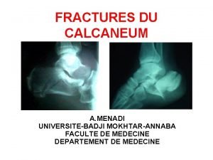 FRACTURES DU CALCANEUM 1 2 A MENADI UNIVERSITEBADJI