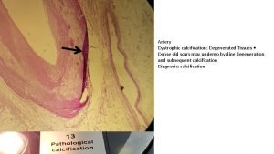 Artery Dystrophic calcification Degenerated Tissues Dense old scars