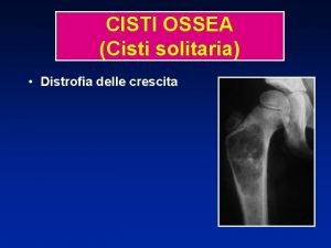 CISTI OSSEA Cisti solitaria Distrofia delle crescita CISTI