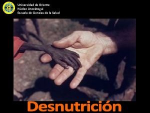 Clasificacion de desnutricion oms