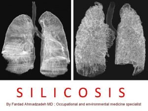 Silicosis radiology