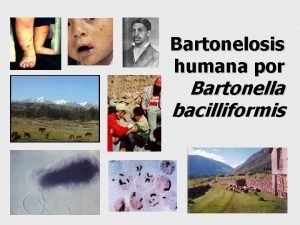 Bartonelosis humana