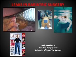 LEAKS IN BARIATRIC SURGERY Paolo Gentileschi Bariatric Surgery