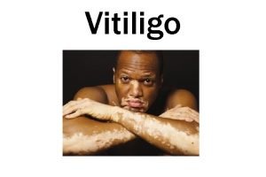 Vitiligo What is vitiligo Vitiligo is a condition