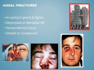 NASAL FRACTURES In contact sports fights Depressed or
