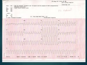 Rbbb vs lbbb Rbbb vs lbbb