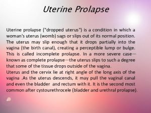 Uterine Prolapse Uterine prolapse dropped uterus is a