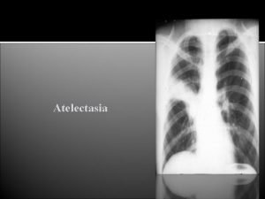 Atelectasia de absorcion