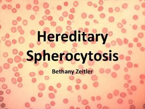 Hereditary spherocytosis usmle