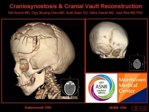 Dolichocephaly