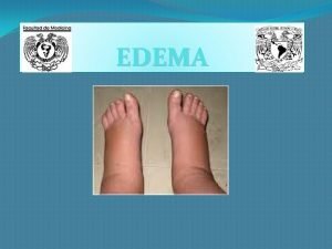 EDEMA Qu es edema Proviene del griego oidema