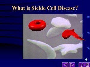 What is Sickle Cell Disease What is Sickle