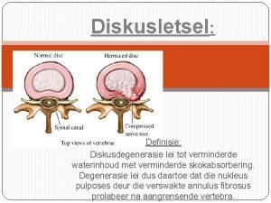 Diskusletsel Definisie Diskusdegenerasie lei tot verminderde waterinhoud met