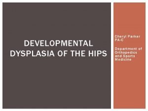 Developmental dysplasia of hip treatment
