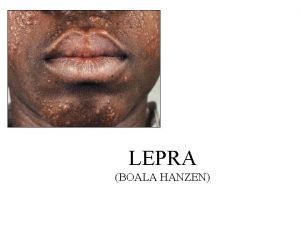 Lepra boala