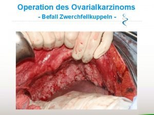 Operation des Ovarialkarzinoms Befall Zwerchfellkuppeln Operation des Ovarialkarzinoms